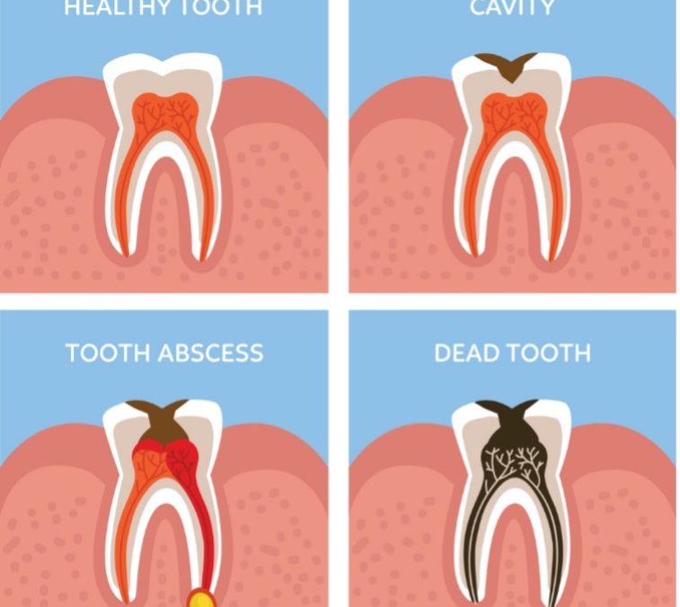 four types of tooth stages, root canal