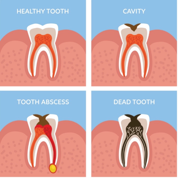 broken molar no pain