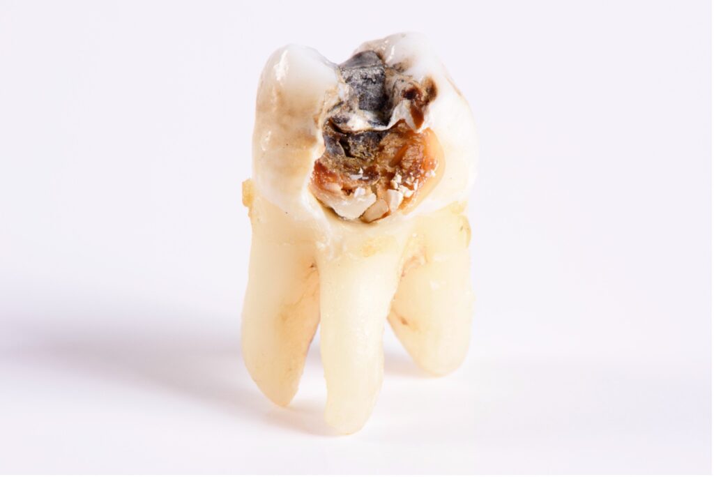 A decayed tooth, Unraveling the Myth: Exploring Ancient Beliefs About Tooth Worms and Dental Decay